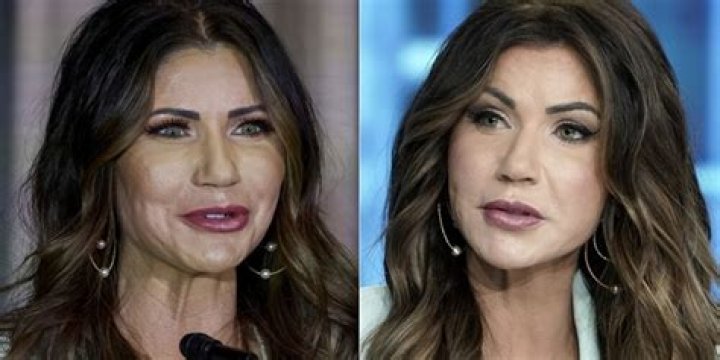 Kristi Noem Before Plastic Surgery: A Deep Dive into Her Transformation