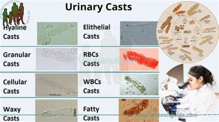 Understanding Cerumen Casts: What You Need to Know