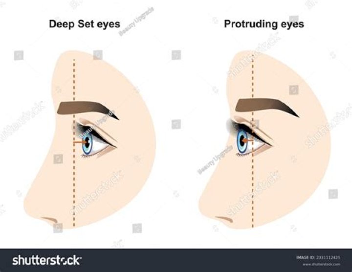 Understanding Deep Set Eyes: Beauty, Challenges, and More